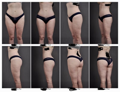low c of g lipo 34 Yr/old (Almost Full Body) and J-Plasma Review Kiperin Burn | L-Karnitin,
