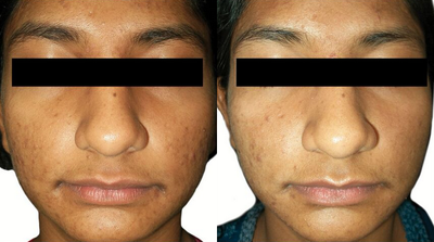 Venus Viva - Before and After 6 Treatments. &nbsp;Photos provided courtesy of Venus Concept, performed by Megha Joy Shah, MD.