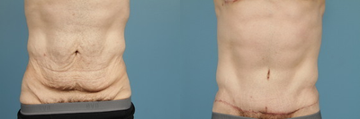 Tummy Tuck (Abdominoplasty) - 
	Tummy Tuck
