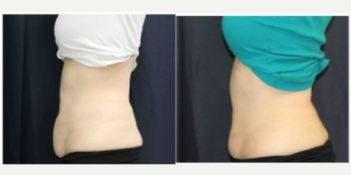 53 year old woman treated with SculpSure - SculpSure treatment of the lower abdomen 53 y/o female, 13 weeks out & 2 treatments