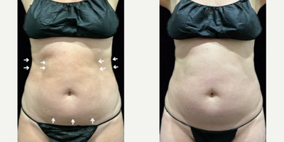Woman treated with SculpSure - Woman treated with SculpSure