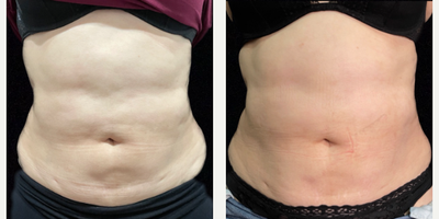 Woman treated with SculpSure - Woman treated with SculpSure