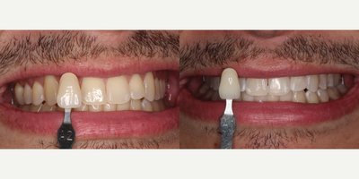 25-34 year old man treated with Zoom Whitening - 2 hour chairside whitening procedure