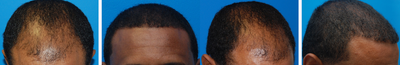 Hair Transplant Before & After - 46 Year-Old Male, 2600 Grafts, 20 Months Post Op - 
	46 year-old male with a 20 year history of male pattern baldness. We were able to harvest 2600 grafts and because his hair was so curly, we cut the dissected grafts to size and reserved the ultra fine FUs for the frontal hairline. The results are shown for 20 months post operatively.
