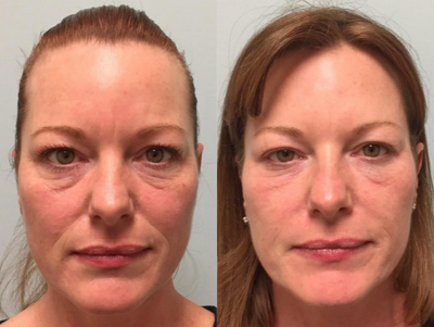 ALMI (Autologous Lipocyte Micronized Injection) for Facial Rejuvenation - This patient is seen here before and after facial rejuvenation with ALMI (Autologous Lipocyte Micronized Injection).