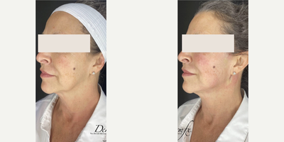 35-44 year old woman treated with Thread Lift, Contour Thread Lift - Threads are resorbable surgical sutures composed of biodegradable polymers. The treatment is minimally invasive and produces instant results. Polydioxanone (PDO) sutures are used for biomedical applications, particularly in cardiothoracic surgery because it is fully absorbed by hydrolysis within 4 to 6 months and doesnt create any scar tissue. The foreign body stimulates collagen synthesis and the skin structure created will hold for 12 to 15 months.Can be used for :-Eye Lift-Full Face-Neck-Rhinoplasty-Upper/Lower
