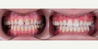 25-34 year old man treated with Dental Bonding, Teeth Whitening - 2534 year old male patient was treated with dental bonding to repair minor chips and uneven edges, followed by in-office teeth whitening. The combined approach enhanced both the shape and brightness of his smile in a minimally invasive procedure.