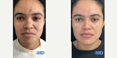 25-34 year old woman treated with Pico Genesis, Skin Rejuvenation, Skin Lightening - This young lady saw amazing results for her skin after our combo of PICO genesis and DiamondGlow Facial!!