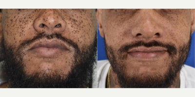 Two Q-switched laser treatments for black male with full face freckles before and after. - Patient is a middle aged black male concerned with the very dark freckling he had throughout the face.  We used the Palomar Q-yag V laser to lighten these freckles significantly after two treatments.  Yes, dark skin can be treated for age spots and freckles but technology and experience are key.