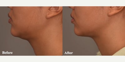Woman treated with Smart Lipo - Woman treated with Smart Lipo in the chin and neck region and Chin Implant