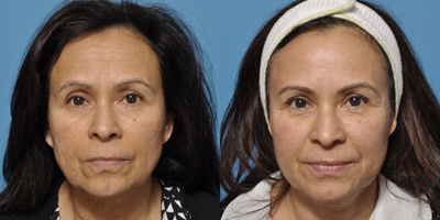 HALO Laser Resurfacing with Botox  - Showing before and six months after Botox to soften the area between the brows and the crows feet and a Sciton HALO combination ablative / non-ablative laser resurfacing procedure. She did not miss any work after the laser treatment and was able to put make up / coverup the very next day while her face was peeling and healing. The laser helped even her pigment and eliminate fine lines.. Usually only one treatment is needed to produce these results.