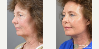 Woman treated with Facelift, Eyelid Surgery - This Facelift + Upper Eyelid Blepharoplasty procedure, Our patient desired a transformation and post-op with Dr. Marotta.