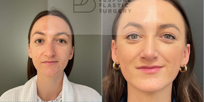 Woman treated with Septoplasty, Alarplasty - Septoplasty with alar base reduction.