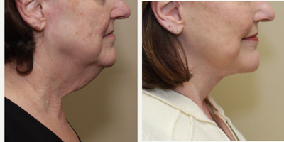 Facelift/Necklift - Open necklift, corset platysmaplasty, SMAS facelift