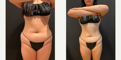 Woman treated with Semaglutide - Woman treated with Semaglutide