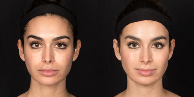 25-34 year old woman treated with Injectable Fillers - Female patient wanted more volume and contour to her cheeks, nasolabial folds and jawline and was treated with Revanesse Versa injectable filler.