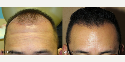 Man treated with Hair Transplant, ARTAS Robotic Hair Transplant - Man treated with Hair Transplant, ARTAS Robotic Hair Transplant