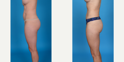 35-44 year old woman treated with Abdominal Etching, Belly Button Surgery, Diastasis Recti Repair, Drainless Tummy Tuck, Liposcu - Before and after bikini incision tummy tuck with VASER ultrasound lipo 360