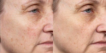 Fraxel Laser Before & After Pictures - RealSelf