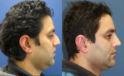 Rhinoplasty - Cosmetic Rhinoplasty, Open Approach