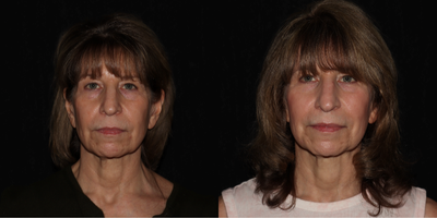 65-74 year old woman treated with Sofwave - This lovely client has a single session of Sofwave lower face and neck (upper face/eyes were not treated). She loves the lift and skin firming that this no downtime collagen restoration procedure has provided. She is now scheduled for a second session which will be full face and neck, as she has been so pleased with her progress. She definitely does not look her age (68) thanks to her commitment to regular medical aesthetic treatments.