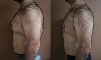 25-34 year old man treated with Gynecomastia Surgery - This gentleman desired chest contouring or gynecomastia surgery to help flatten the chest. Ultrasonic liposuction was performed with J plasma skin tightening (without gland removal in this case). Here he is happy at 2 months postoperative.