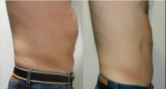 35-44 year old man treated with i-Lipo + carboxytherapy - 12 sessions of iLipo plus 12 sessions of carboxytherapy