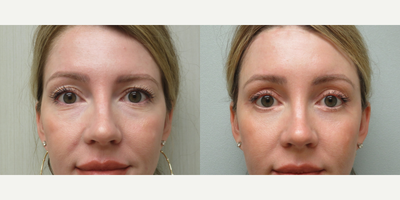 35-44 year old woman treated with Brow Lift, Eyelid Surgery - This patient underwent an endoscopic browlift with a hairline incision and a Quad Blepharoplasty to rejuvenate her upper and lower lids.