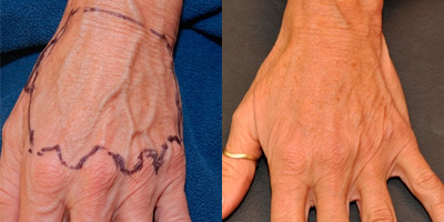 Woman treated with Fat Transfer - Fat Transfer to hands