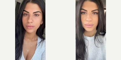 Woman treated with Lip Fillers, Revanesse - Woman treated with Lip Fillers, Revanesse