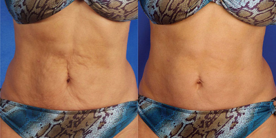 35-44 year old woman treated with Skintyte - SkinTyte before and after one treatment