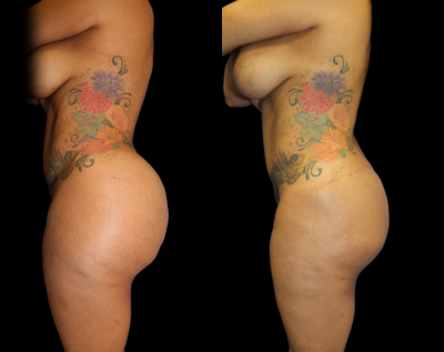 45-54 year old woman treated with Silicone Injection Removal - This patient had raw silicone injected into her buttocks. The raw silicone injections caused her pain, discomfort and caused her buttocks to droop.