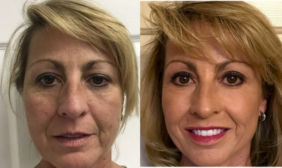 45-54 year old woman treated with Age Spots Treatment - S/p J-Plasma Facial Resurfacing