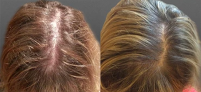 Woman treated with Hair Loss Treatment - Woman treated with Hair Loss Treatment through Theradome Low Level Light Therapy
