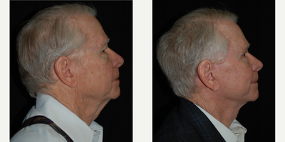65-74 year old man treated with Facelift - Face and Neck Lift with Fat Transfer, Upper Blepharoplasty and Endoscopic Brow Lift