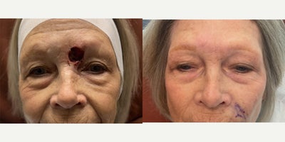 65-74 year old woman treated with Mohs Surgery - 65-74 year old woman treated with Mohs Surgery by Dr. Bonett at Naples Plastic Surgery.