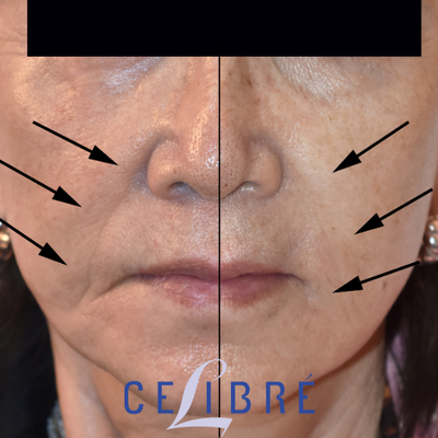 Los Angeles Restylane Injections around the mouth. - Patient is a sixty something woman that wants improvement around the mouth.  softening of the lines next to the nose and underneath the corners of the mouth.  1 Restylane Defyne did a nice job of smoothing out the shadowy contours.