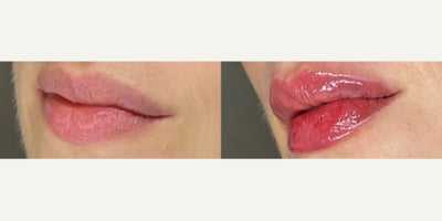 Woman treated with Lip Fillers - Woman treated with Lip Fillers