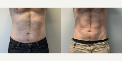 45-54 year old man treated with Emsculpt - Emsculpt NEO 4 months post treatment abdomen
