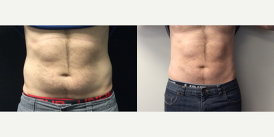 45-54 year old man treated with CoolSculpting - Coolsculpting abdomen and flanks