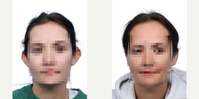 31 year old woman treated with Ear Surgery - This 31-year-old female was concerned about the appearance of prominent ears. She underwent otoplasty, achieving a more natural and harmonious ear contour.