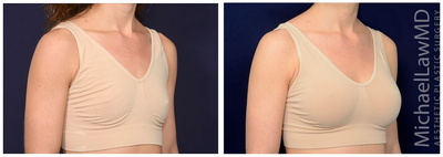 25-34 year old woman treated with Ideal Implant - Breast augmentation. Follow-up photos taken 3 months after the procedure.