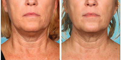 55-64 year old woman treated with Kybella for corruption of sub mental fullness /double chin - 55-64 year old woman treated with Kybella for corruption of sub mental fullness /double chin