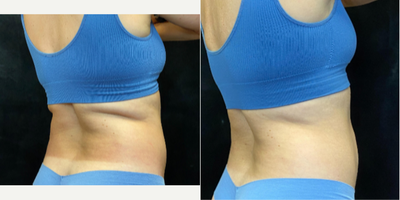 25-34 year old woman treated with Evolve - Pt concern with smoothing back and waistline.