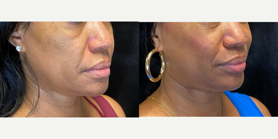 35-44 year old woman treated with Micro Botox, Lip Fillers, Juvederm, Dermal Fillers, Voluma - Ft focus on volume loss of the cheeks and midface. Adding hydration and symmetry. Treated by Aubrey H., RN.