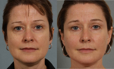 Sculptra - Sculptra injections were used to replace volume naturally.