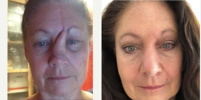 45-54 year old woman treated with Facial Reconstructive Surgery - Status post removal of a extensive basal cell carcinoma