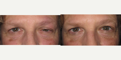 55-64 year old woman treated with Ptosis Surgery - Ptosis repair left upper eyelid