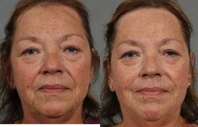 Juvederm, Radiesse, Botox - 
	Patient has lost volume around mouth area. Deeper folds presented, injectable treatment using Juvederm and Radiesse were used for immediate results. Botox was also used to lift the corners of the mouth.
