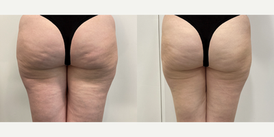 45-54 year old woman treated with Aveli celulite treatment - 45-54 year old woman treated with Aveli celulite treatment